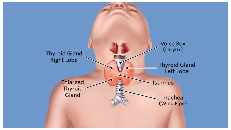 TIPS MERAWAT HYPERTHYROID TANPA STEROID  Sihat dan cergas 