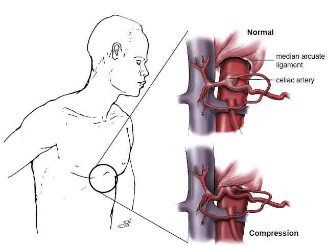 celiac artery compression syndrome