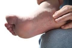 plantar fasciitis