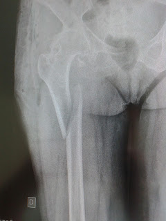 Raio X imagem de fratura no femur