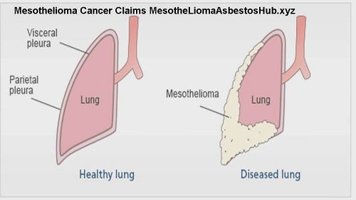 Mesothelioma Commercial Annoying