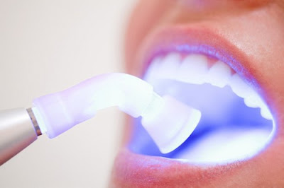 Ưu điểm của tẩy trắng răng Laser Whitening 