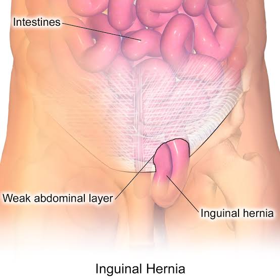 can-you-get-a-hernia-if-you-have-weak-abdominal-muscles