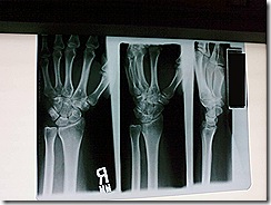 handxray