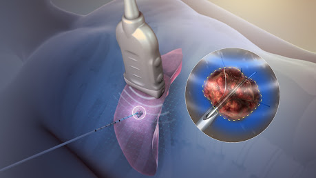 Radiofrequency Ablation Devices