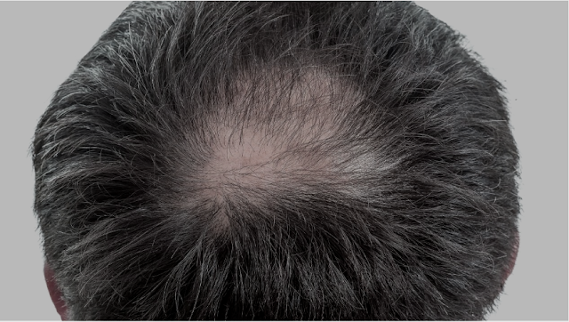 Causes of hair loss for men and proven ways to treat it