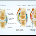 Apa itu Arthritis ( Radang sendi ) ???