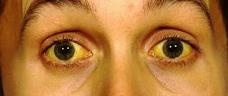 Jaundice:types, symptoms, treatment