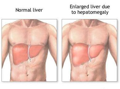 How do we know if our liver is inflamed?