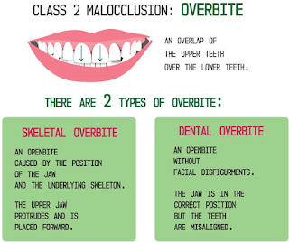 Class 2 Malocclusion