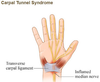 Hand Surgery can correct carpal tunnel syndrome in some cases.