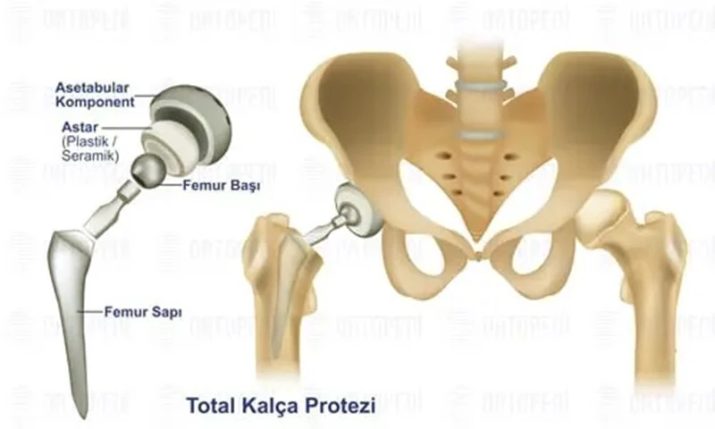Kalça Protezi Ameliyatı Nedir?