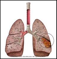 penyakit pneumonia