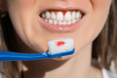 tooth decay cleaning