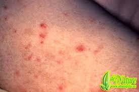 Raja singa sipilis Raja singa sipilis