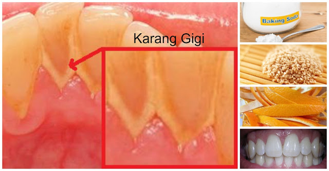 Ingin Gigi Putih Bersih Tanpa Karang Gigi ? Ikuti 12 Cara Briliant Berikut Ini, Karang Gigi Akan Lenyap Seumur Hidup !!