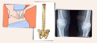 Joint-replacement-spine