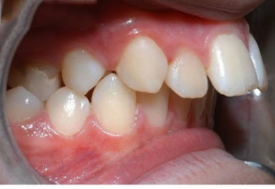 Dấu hiệu nhận biết bị hô răng