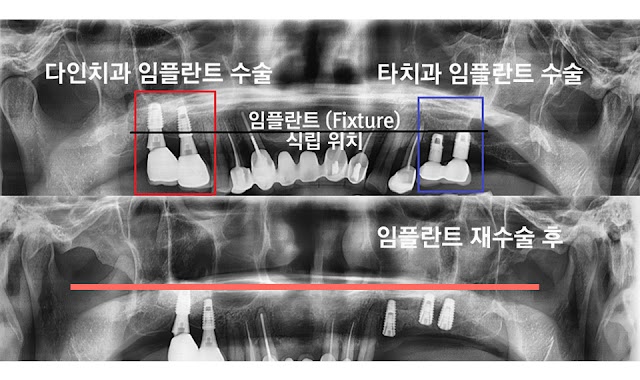 임플란트 사용 기간 얼마나 되나? 