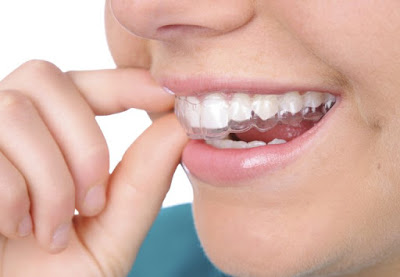 Tẩy trắng răng an toàn và hiệu quả tại nha khoa