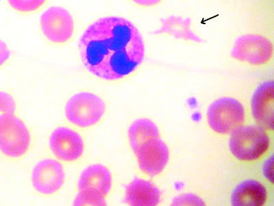 Peyebab-Anemia-Hemolitik