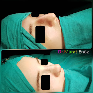 Female Rhinoplasty Istanbul Turkey, Nose Job in Women, Rhinoplasty Istanbul