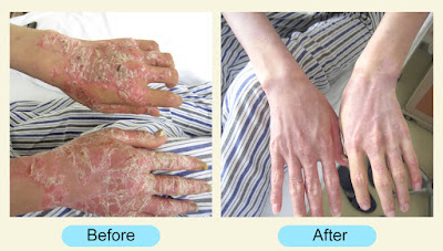 Can You Cure Psoriasis?