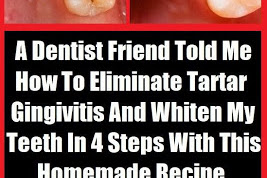 My Dentist Brother Told Me How To Eliminate Tartar, Gingivitis And Whiten My Teeth In 4 Steps With This Homemade Recipe
