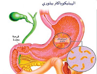  جرثومة المعدة Helicobacter pylori