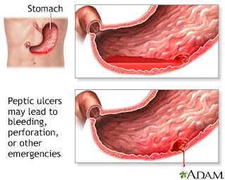 Symptoms of Peptic Ulcer