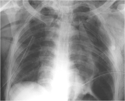 �Fracture of 1st and 2nd ribs.