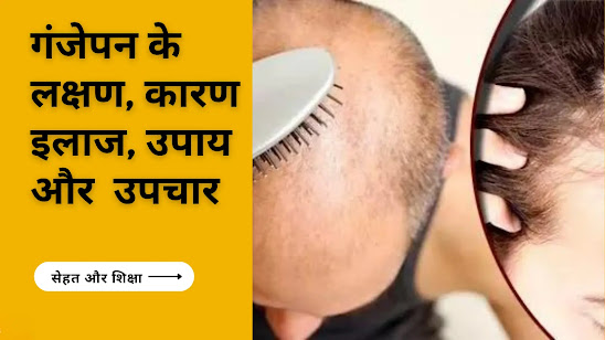 गंजापन (गंजे होने) के लक्षण, कारण, इलाज, उपाय और उपचार Baldness Symptoms, Causes, Treatment, Medicines, and Treatment in Hindi