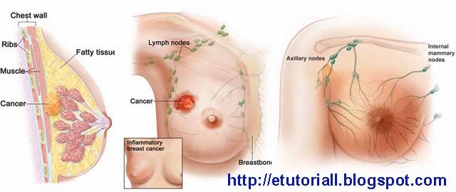 Tips Cara Mencegah Kanker Payudara