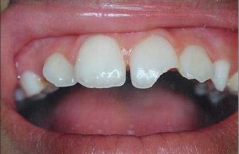 Răng hô, sứt mẻ do trấn thương, răng sau điều trị tủy… bọc răng sứ sẽ là giải pháp tốt nhất