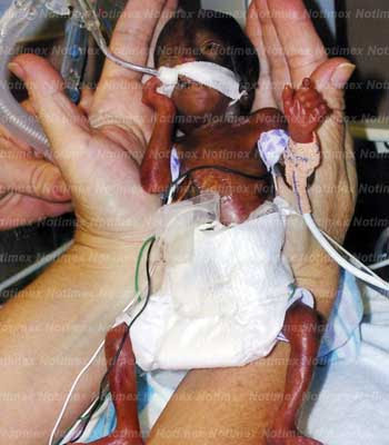 fotos de bebes prematuros. EN BEBÉS PREMATUROS
