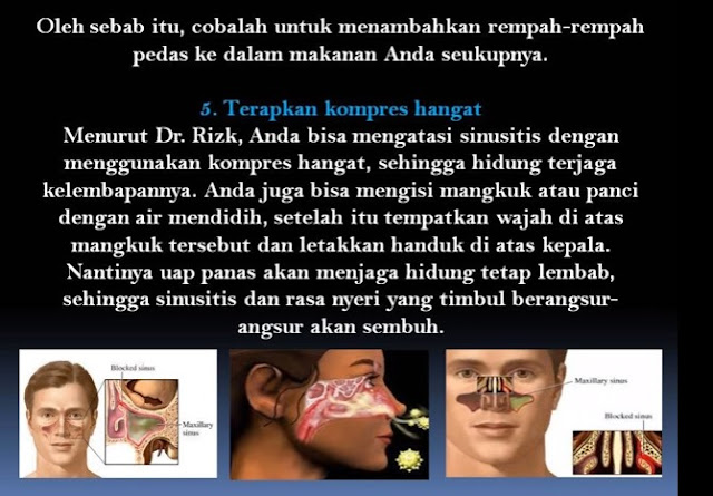 Cara Mudah Mengobati dan Mengenali Penyakit Sinusitis