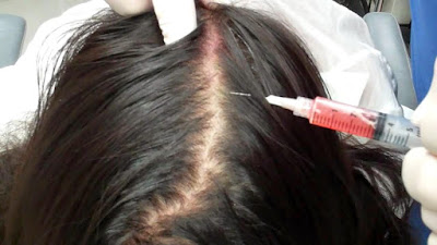 حقن البلازما لعلاج تساقط الشعر