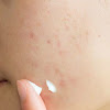 How to prevent from Scars of Pimples : prevent acne in your home