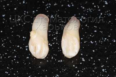 Сверхкомплектные зубы после удаления