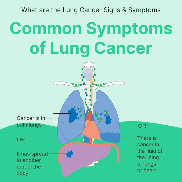 What are the Lung Cancer Signs & Symptoms | Common Symptoms of Lung Cancer