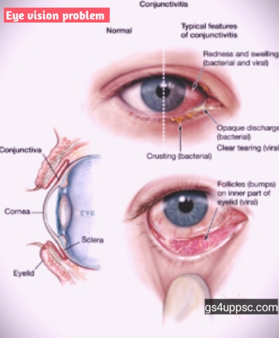 Eye vision problem | Eye problems | Common eye disease | Types of eye problems 