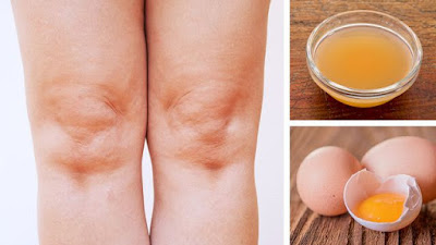 USE ACV AND EGG YOLKS FOR KNEE PAIN