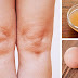 USE ACV AND EGG YOLKS FOR KNEE PAIN