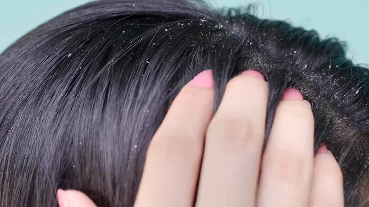 at home treatments for dandruff