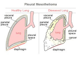 Pleural Mesothelioma