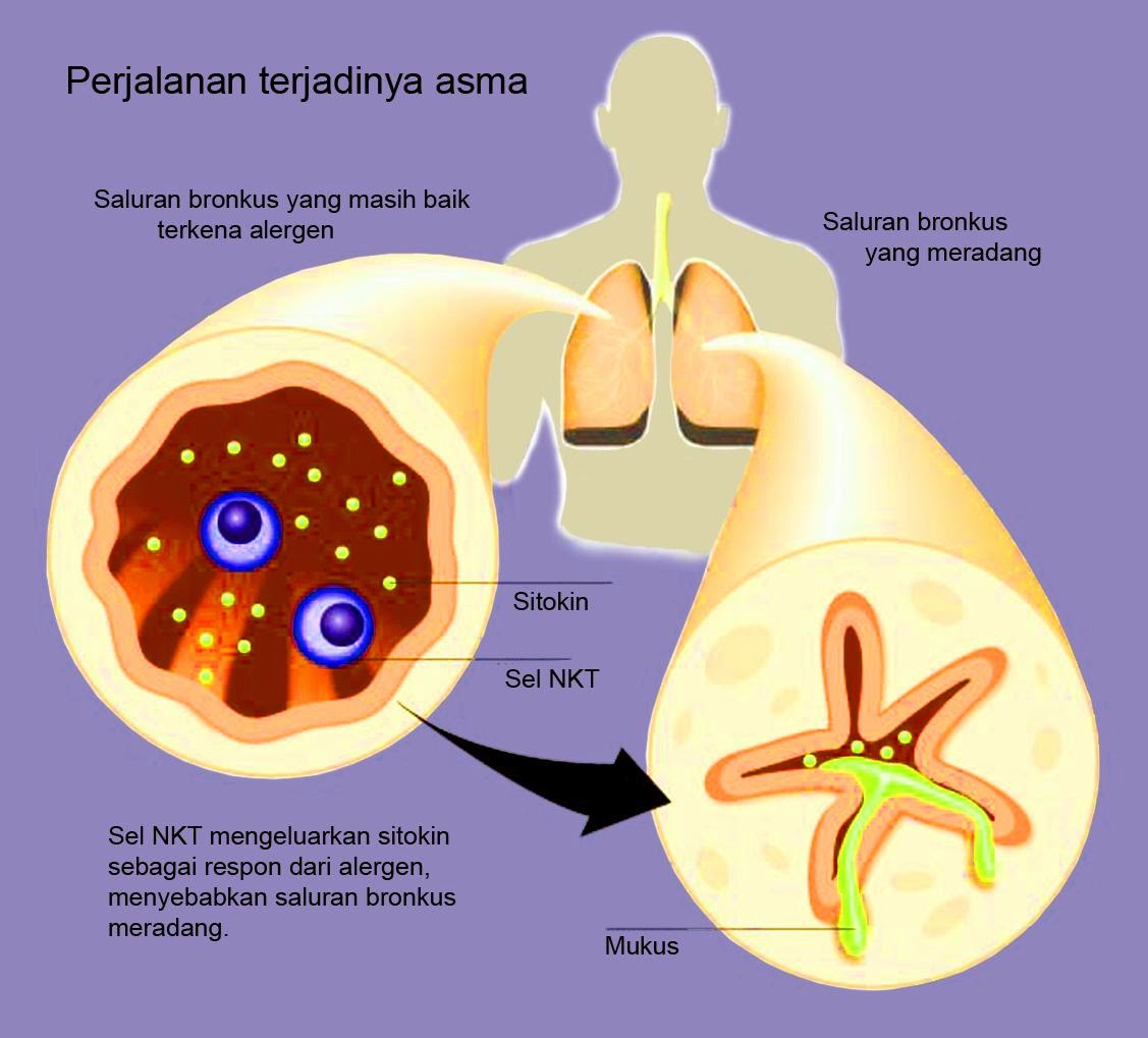  Penyakit  Asma  Tips Pengobatannya