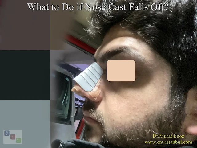 What to Do if Nose Cast Falls Off?