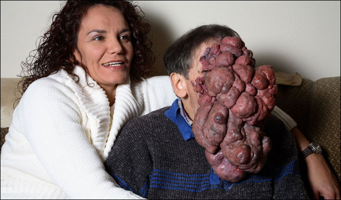 FIREBERT: Neurofibromatosis, Facial tumor.