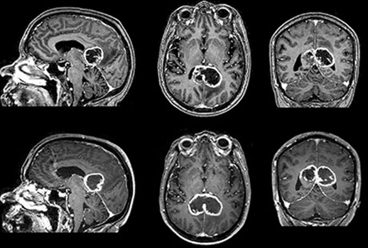 abnormal mri brain