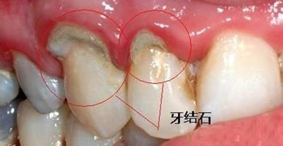 Vincent Yum Blog 沒想到 洗牙真相 是這樣的 醫生從沒公布 大家都被騙了